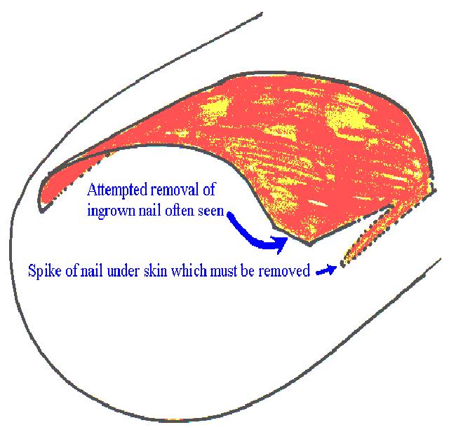 Cartoon of Ingrowing Toenail