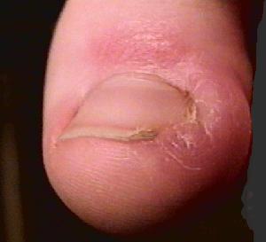 An Ingrowing Toenail